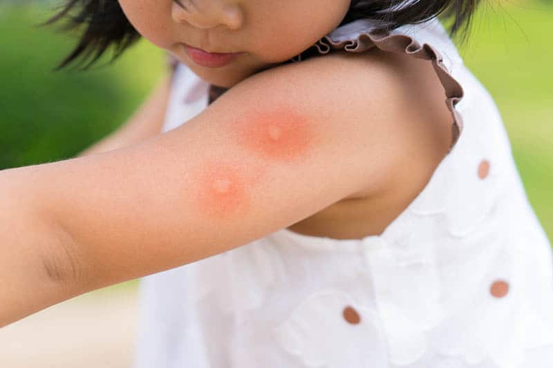 Mosquito Bites On Babies The Best Ways To Manage The Menace