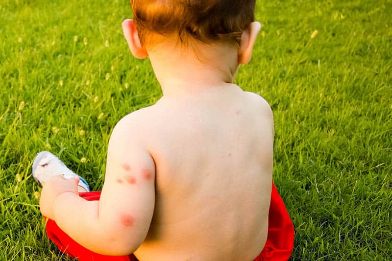 mosquito-bites-on-babies-the-best-ways-to-manage-the-menace