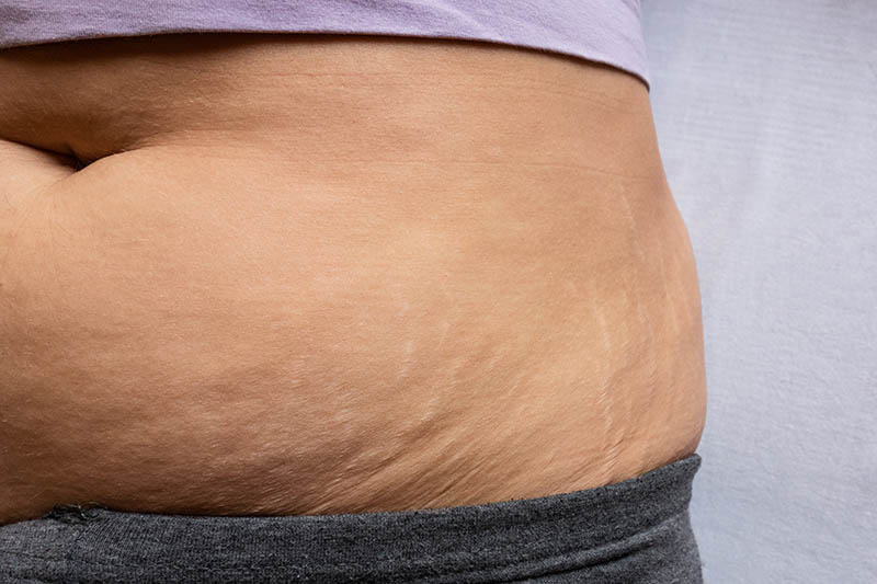 Woman with Postpartum swelling