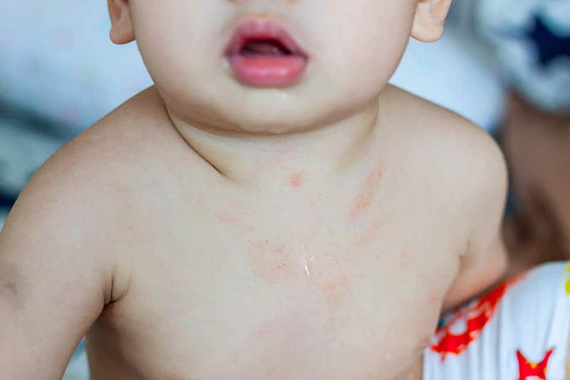 Allergic reaction to egg yolk in babies