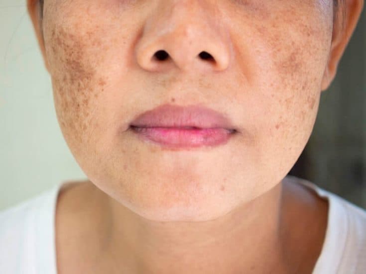 What Is A Pregnancy Mask (Melasma) & What Can You Do About It?