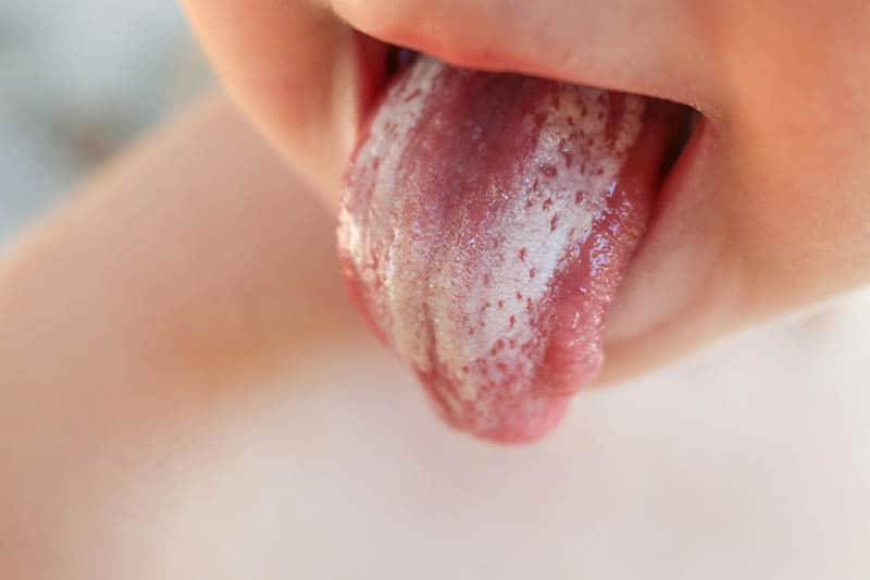 White coating on tongue baby